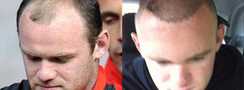 Celebs who had hair transplant